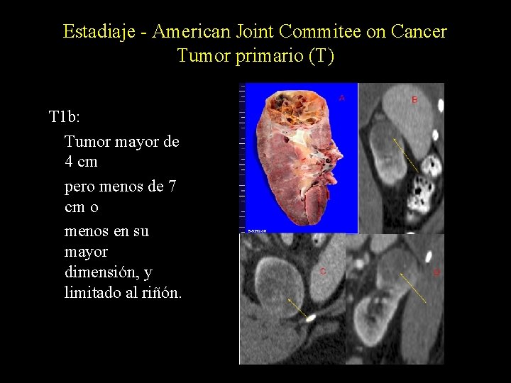 Estadiaje - American Joint Commitee on Cancer Tumor primario (T) T 1 b: Tumor