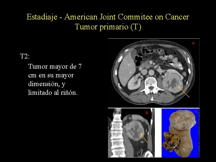 Estadiaje - American Joint Commitee on Cancer Tumor primario (T) T 2: Tumor mayor