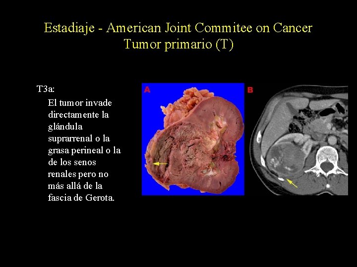 Estadiaje - American Joint Commitee on Cancer Tumor primario (T) T 3 a: El