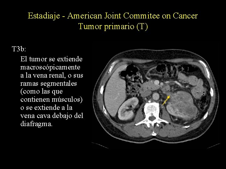 Estadiaje - American Joint Commitee on Cancer Tumor primario (T) T 3 b: El