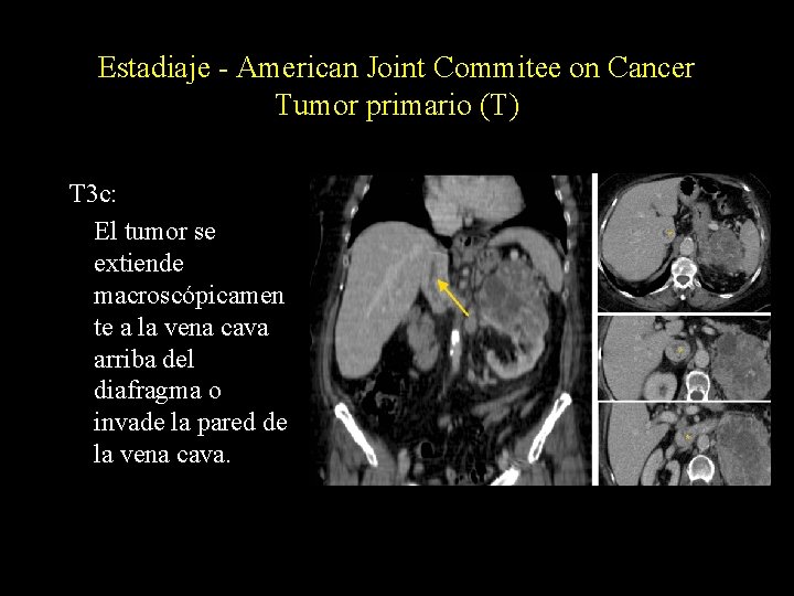 Estadiaje - American Joint Commitee on Cancer Tumor primario (T) T 3 c: El