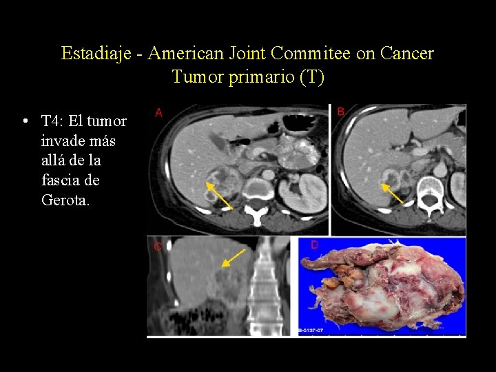 Estadiaje - American Joint Commitee on Cancer Tumor primario (T) • T 4: El