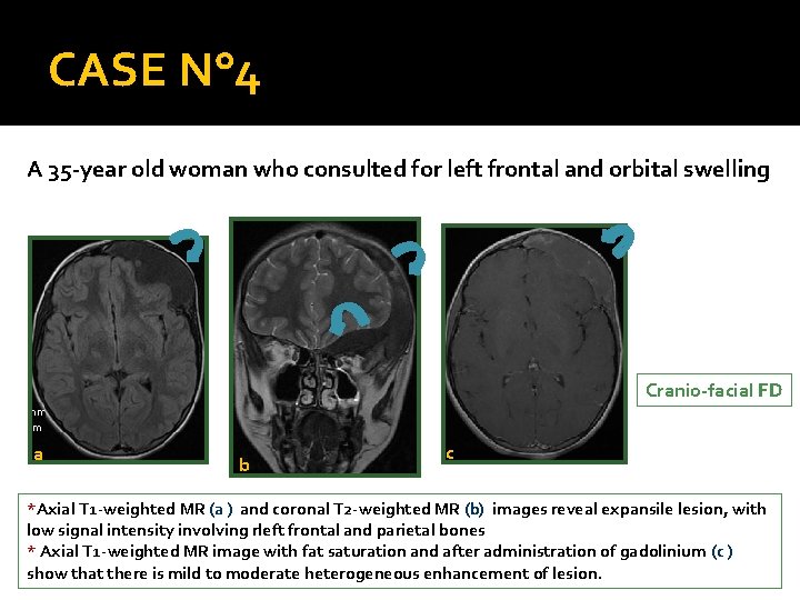 CASE N° 4 A 35 -year old woman who consulted for left frontal and