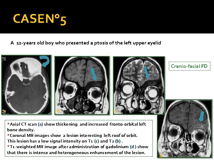 CASEN° 5 A 12 -years old boy who presented a ptosis of the left