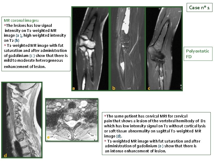 Case n° 1 MR coronal images: *The lesions has low signal intensity on T