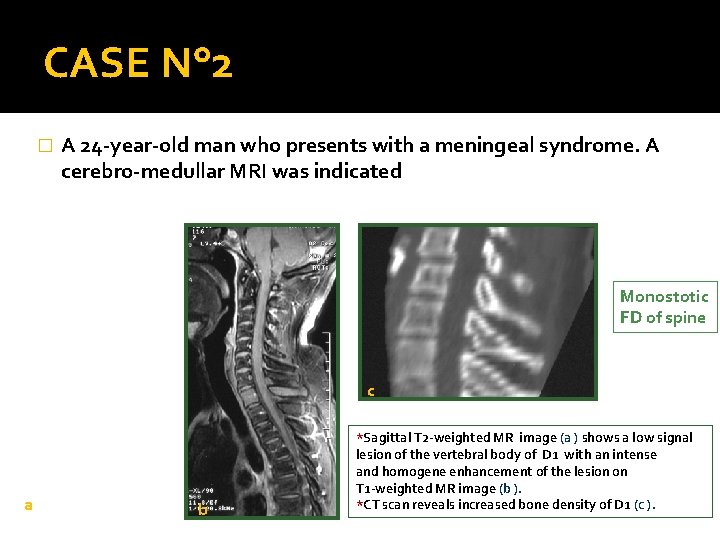 CASE N° 2 � A 24 -year-old man who presents with a meningeal syndrome.