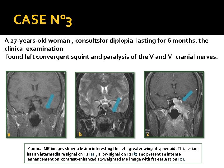 CASE N° 3 A 27 -years-old woman , consultsfor diplopia lasting for 6 months.