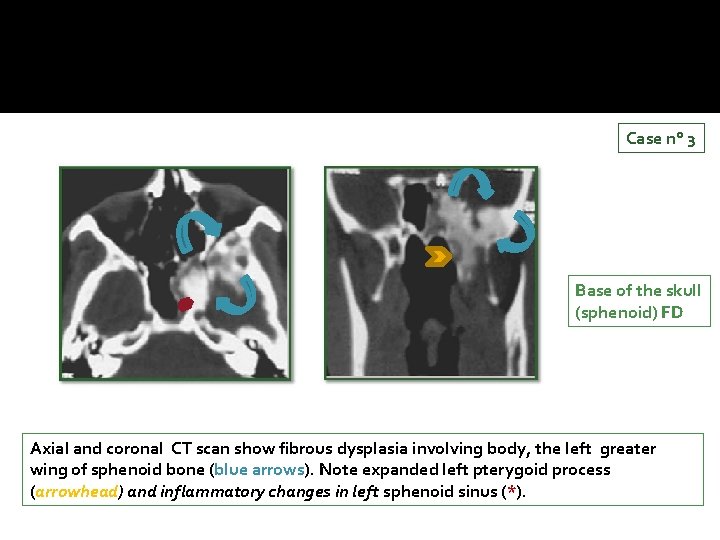 Case n° 3 Base of the skull (sphenoid) FD Axial and coronal CT scan