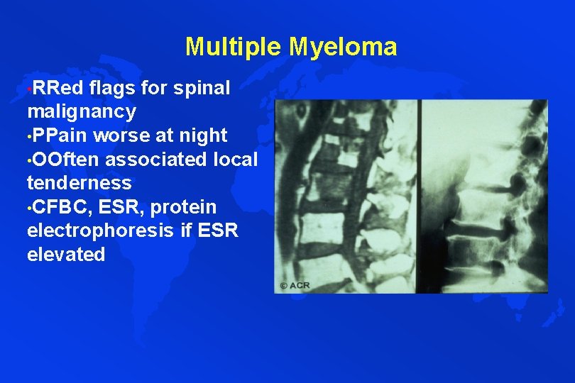 Multiple Myeloma • RRed flags for spinal malignancy • PPain worse at night •