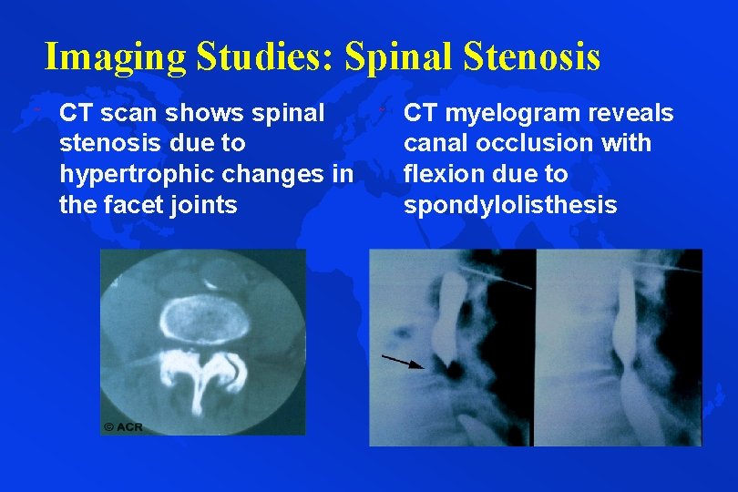 Imaging Studies: Spinal Stenosis ˜ CT scan shows spinal stenosis due to hypertrophic changes