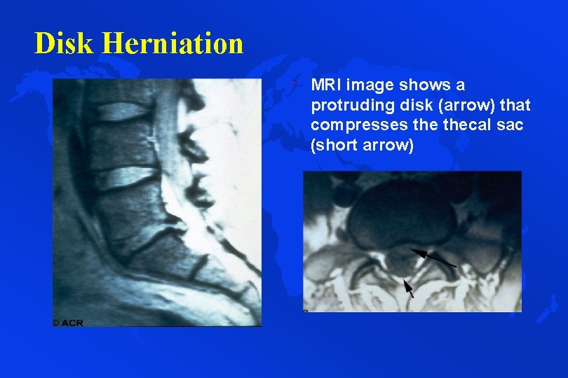 Disk Herniation ˜ MRI image shows a protruding disk (arrow) that compresses thecal sac