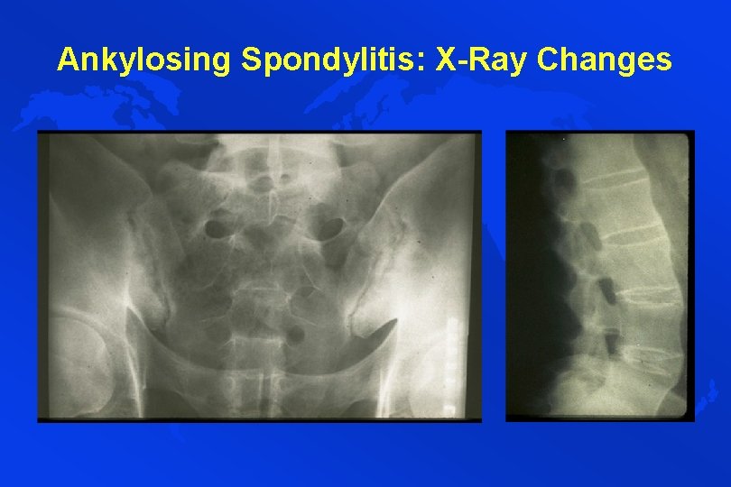 Ankylosing Spondylitis: X-Ray Changes 