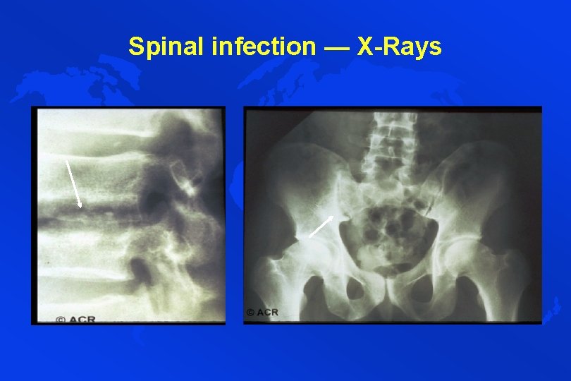 Spinal infection — X-Rays 