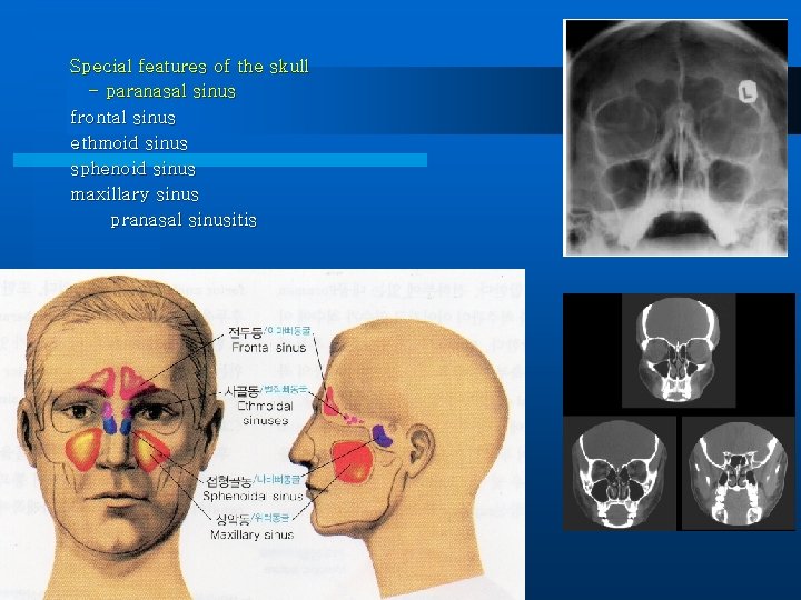 Special features of the skull - paranasal sinus frontal sinus ethmoid sinus sphenoid sinus