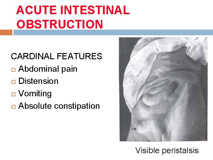 ACUTE INTESTINAL OBSTRUCTION CARDINAL FEATURES Abdominal pain Distension Vomiting Absolute constipation Visible peristalsis 