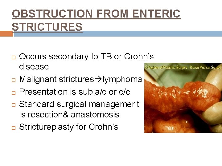 OBSTRUCTION FROM ENTERIC STRICTURES Occurs secondary to TB or Crohn’s disease Malignant strictures lymphoma