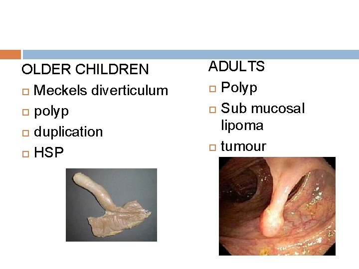 OLDER CHILDREN Meckels diverticulum polyp duplication HSP ADULTS Polyp Sub mucosal lipoma tumour 