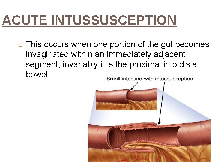 ACUTE INTUSSUSCEPTION This occurs when one portion of the gut becomes invaginated within an