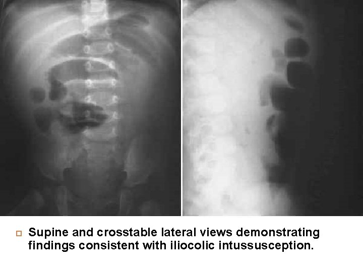  Supine and crosstable lateral views demonstrating findings consistent with iliocolic intussusception. 