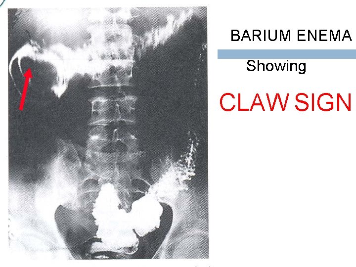 BARIUM ENEMA Showing CLAW SIGN 