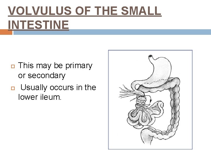 VOLVULUS OF THE SMALL INTESTINE This may be primary or secondary Usually occurs in