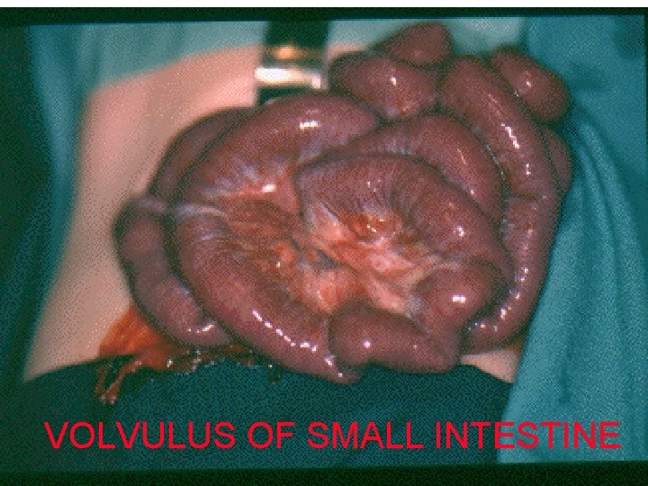 VOLVULUS OF SMALL INTESTINE 