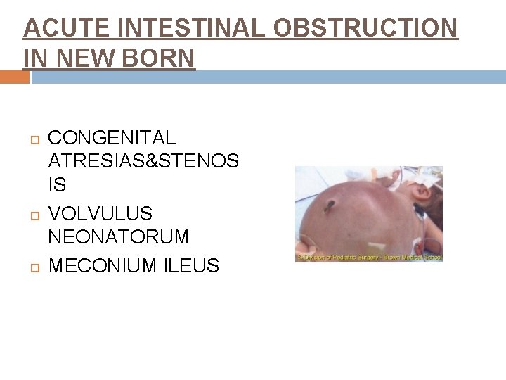 ACUTE INTESTINAL OBSTRUCTION IN NEW BORN CONGENITAL ATRESIAS&STENOS IS VOLVULUS NEONATORUM MECONIUM ILEUS 