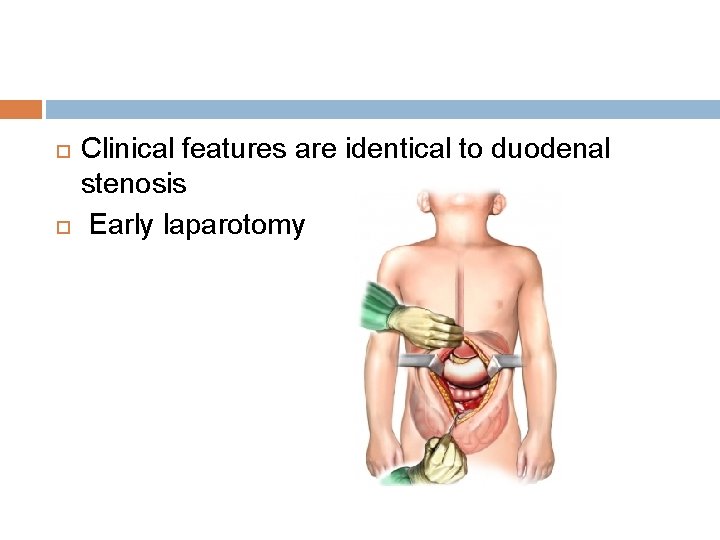  Clinical features are identical to duodenal stenosis Early laparotomy 