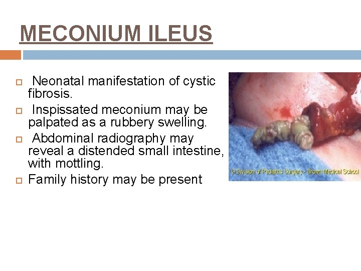 MECONIUM ILEUS Neonatal manifestation of cystic fibrosis. Inspissated meconium may be palpated as a