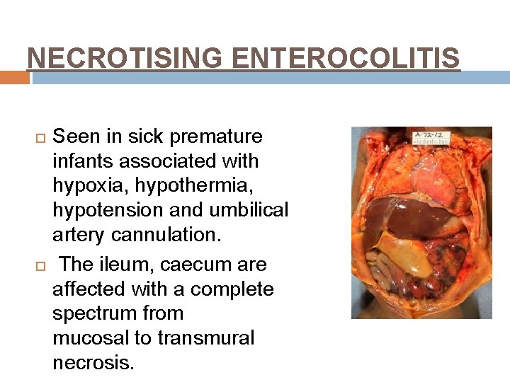 NECROTISING ENTEROCOLITIS Seen in sick premature infants associated with hypoxia, hypothermia, hypotension and umbilical