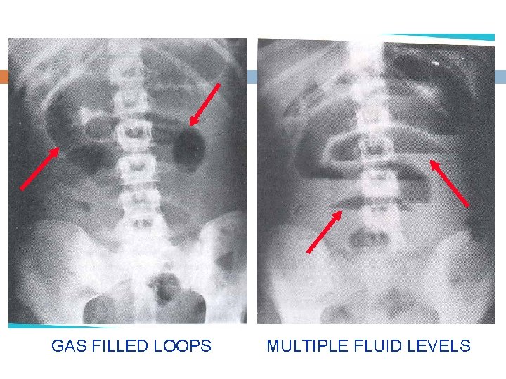 GAS FILLED LOOPS MULTIPLE FLUID LEVELS 