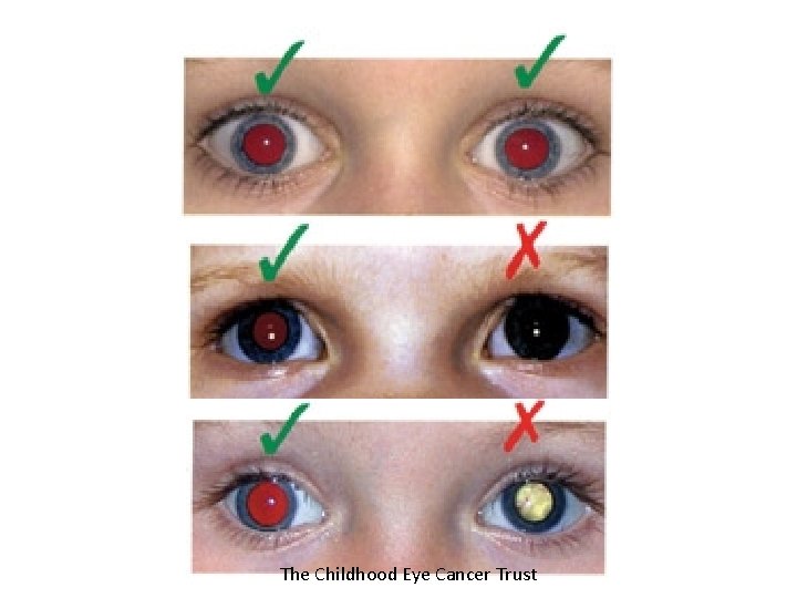 The Childhood Eye Cancer Trust 