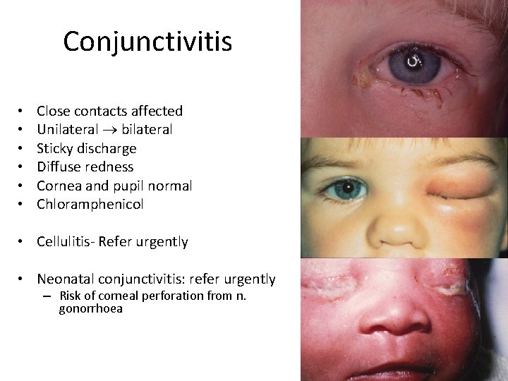 Conjunctivitis • • • Close contacts affected Unilateral bilateral Sticky discharge Diffuse redness Cornea