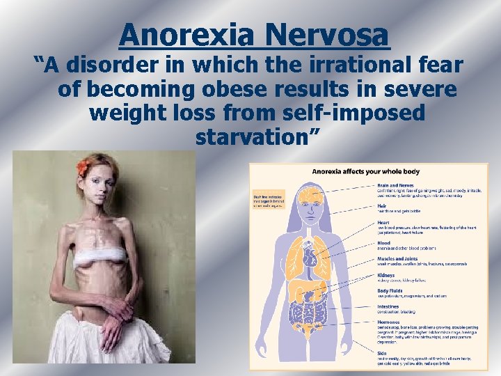 Anorexia Nervosa “A disorder in which the irrational fear of becoming obese results in