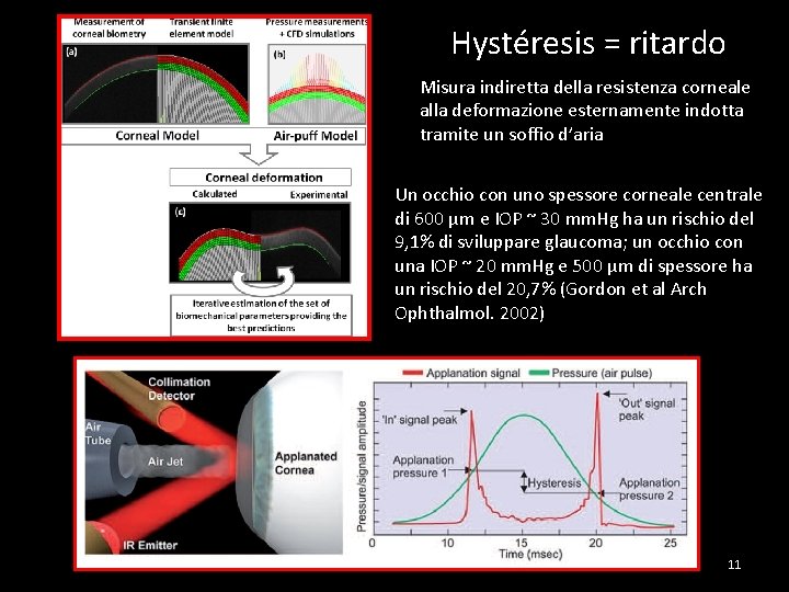 Hystéresis = ritardo Misura indiretta della resistenza corneale alla deformazione esternamente indotta tramite un