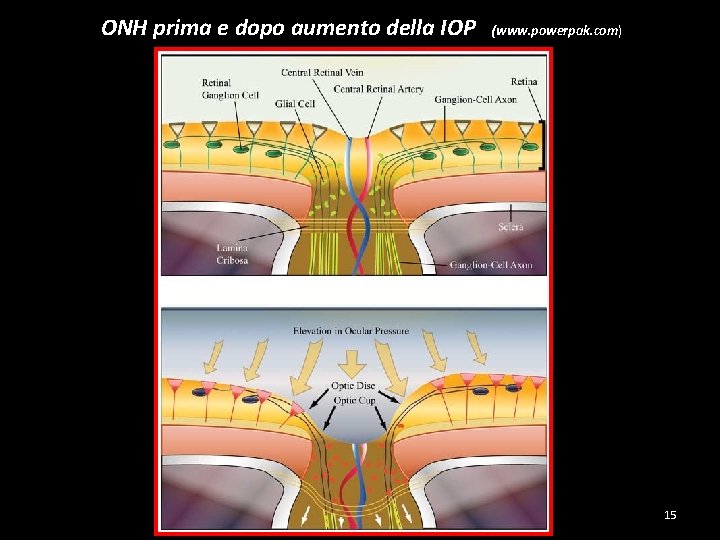 ONH prima e dopo aumento della IOP (www. powerpak. com) 15 