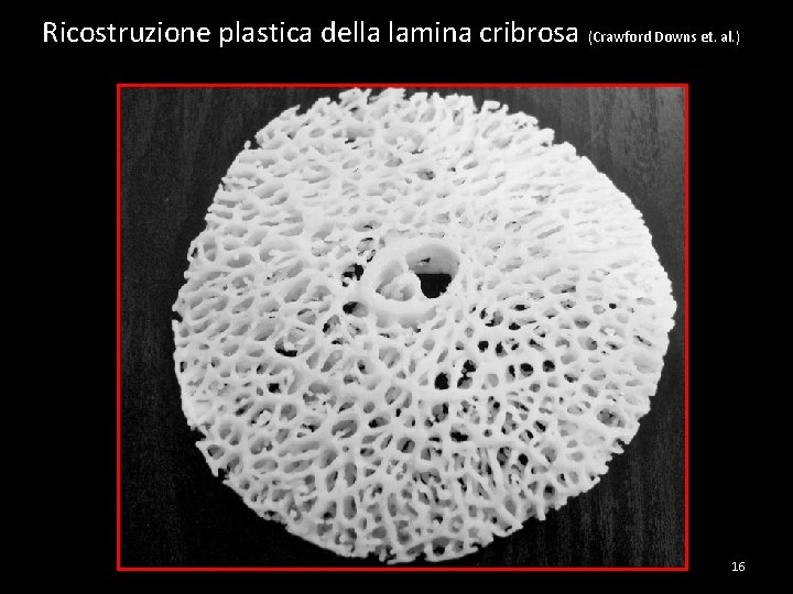 Ricostruzione plastica della lamina cribrosa (Crawford Downs et. al. ) 16 