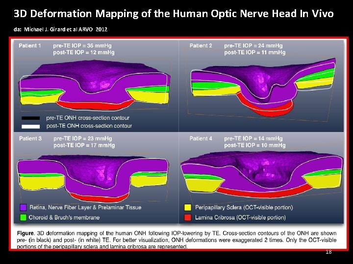 3 D Deformation Mapping of the Human Optic Nerve Head In Vivo da: Michael