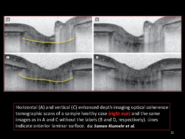 Horizontal (A) and vertical (C) enhanced depth imaging optical coherence tomographic scans of a