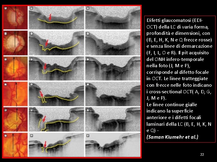 Difetti glaucomatosi (EDIOCT) della LC di varia forma, profondità e dimensioni, con (B, E,