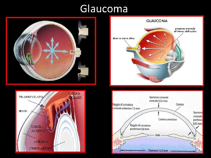 Glaucoma 4 