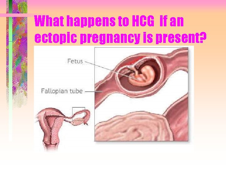 What happens to HCG if an ectopic pregnancy is present? 