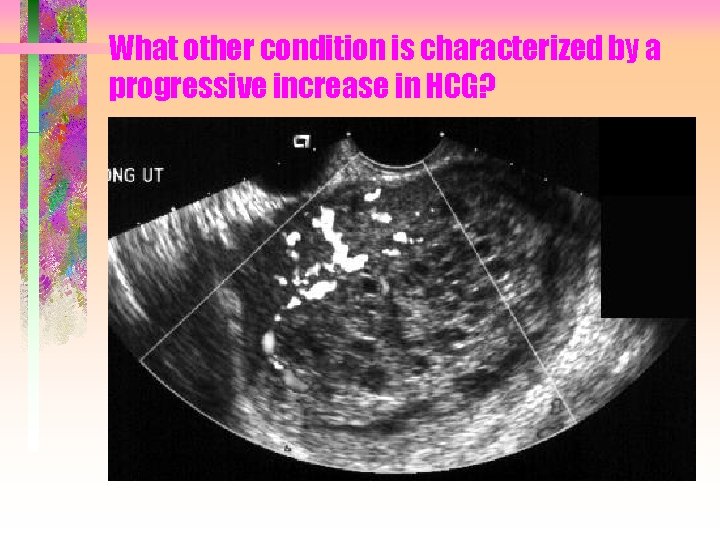 What other condition is characterized by a progressive increase in HCG? 