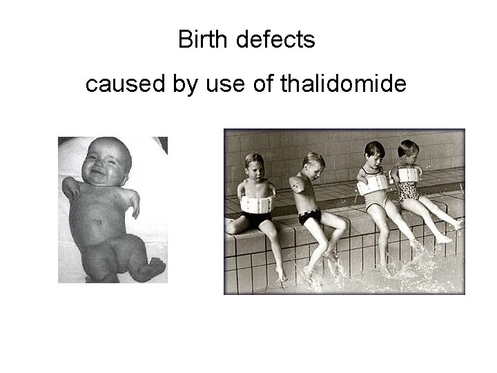 Birth defects caused by use of thalidomide 