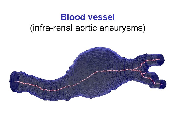 Blood vessel (infra-renal aortic aneurysms) 