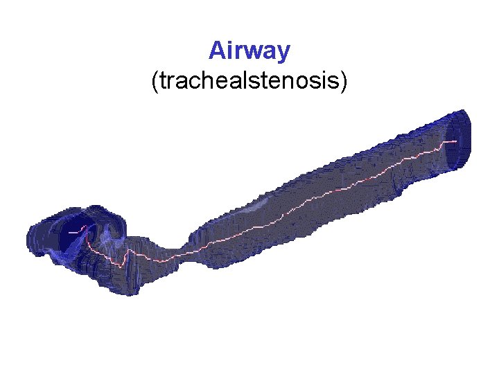 Airway (trachealstenosis) 