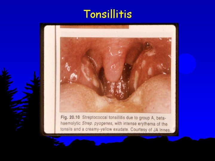 Tonsillitis 