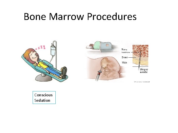 Bone Marrow Procedures Conscious Sedation 