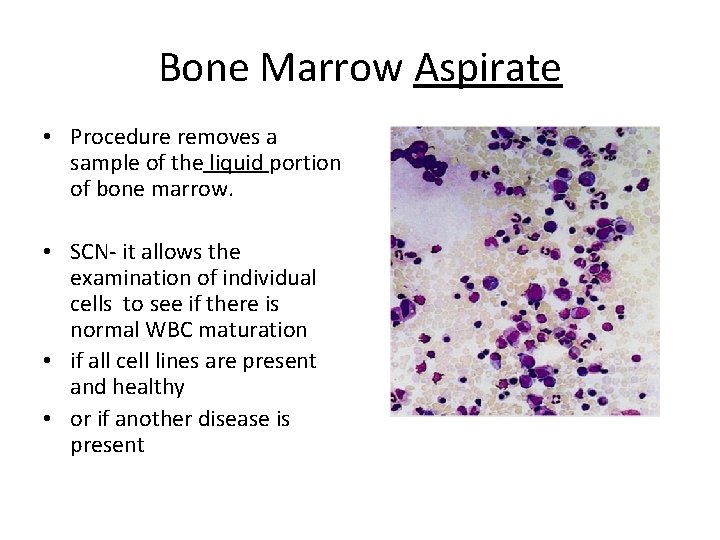 Bone Marrow Aspirate • Procedure removes a sample of the liquid portion of bone