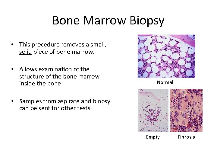 Bone Marrow Biopsy • This procedure removes a small, solid piece of bone marrow.